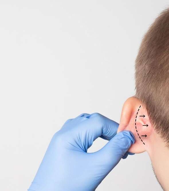 İzmir Kepçe Kulak Ameliyatı (Otoplasti)